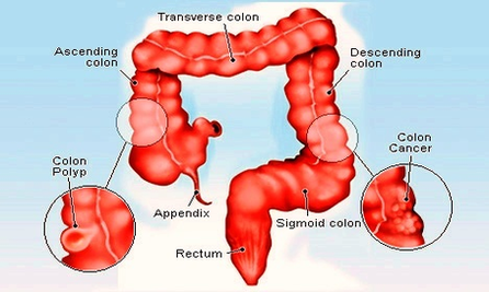 detail colon cancer | Anatomy System - Human Body Anatomy diagram and