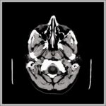 CT Scan Head Scanning Diagram