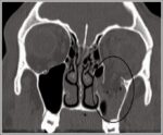CT Scan of a Blowout Fracture of the Inferior Wall. Diagram