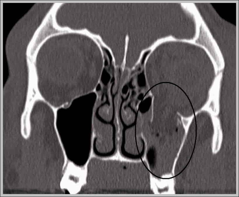CT Scan of a Blowout Fracture of the Inferior Wall. Diagram