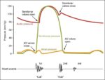 Cardiac Cycle vs Heart Sounds