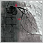 Coronary Angiogram with Narrowing Labelled Diagram