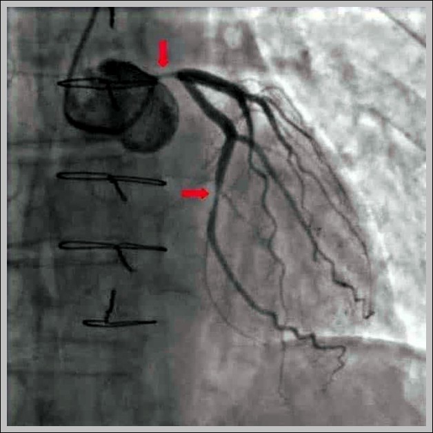 Coronary Angiogram with Narrowing Labelled Diagram