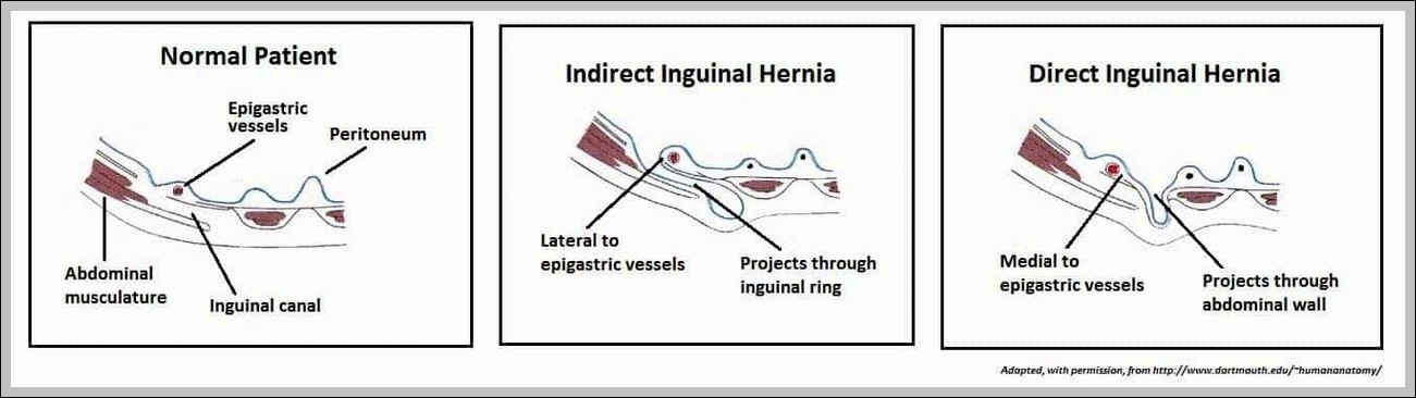 Direct Inguinal Hernia vs Indirect Inguinal Hernia Regional Anatomy Diagram