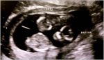 Identical Twin Ultrasound Image scaled