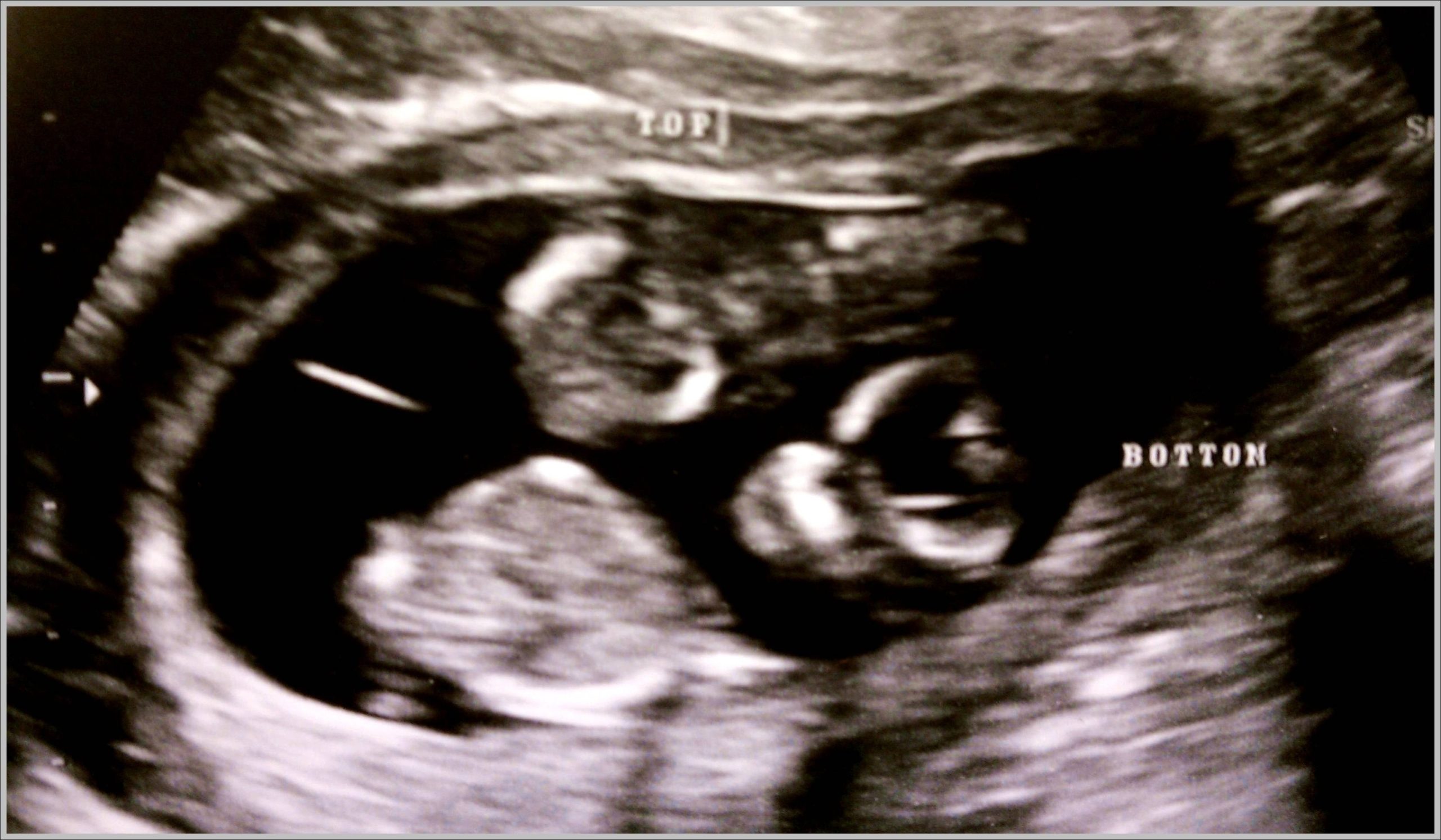 Identical Twin Ultrasound Image scaled