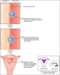 Implantation