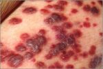 Kaposis Sacroma Lesions