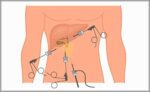 Laparoscopic Cholecystectomy Diagram