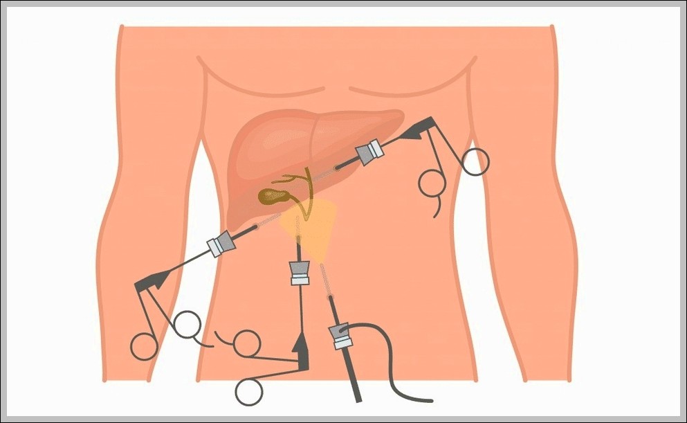 Laparoscopic Cholecystectomy Diagram