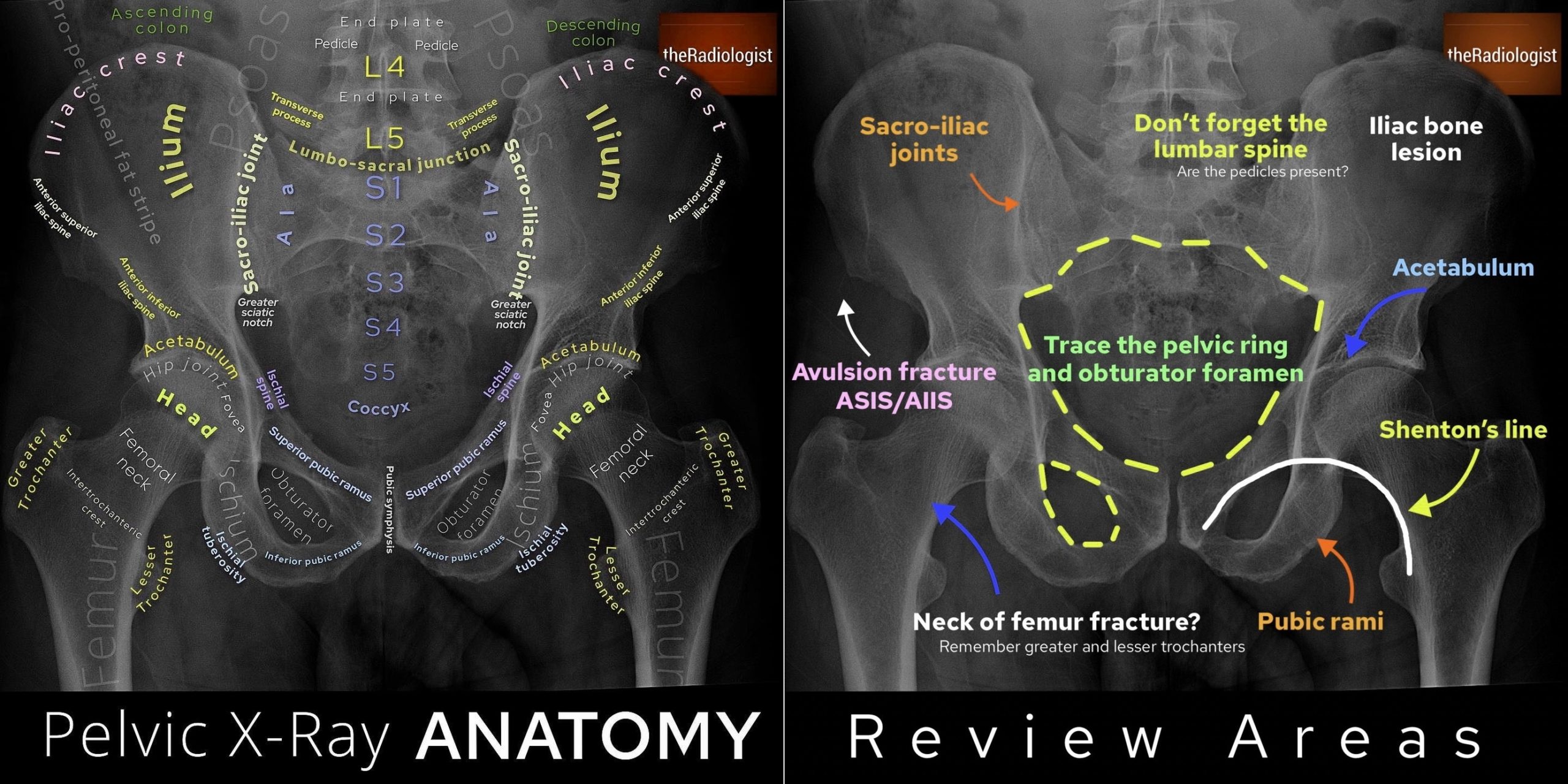 Male Pelvis X Rayap Hip X Ray