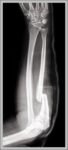 Monteggia Fracture of the Radius and Ulna Diagram