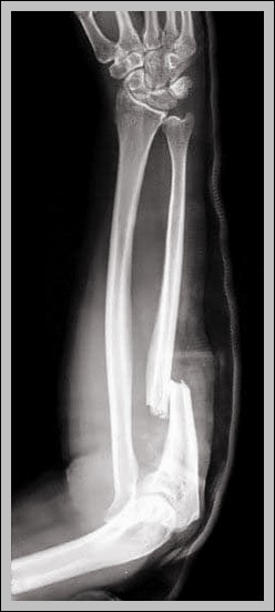 Monteggia Fracture of the Radius and Ulna Diagram