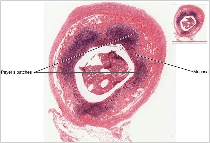 Mucosa Associated Lymphoid Tissue MALT Nodule