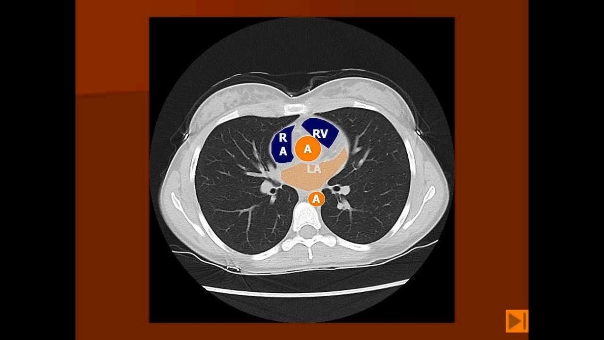 Normal Chest Ct With Labels