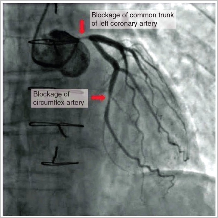 Occluded Coronay Arteries
