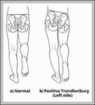 Positive Trendlenburg Test Diagram