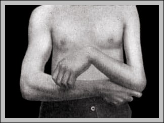 Radial Nerve Palsy Wristdrop Diagram