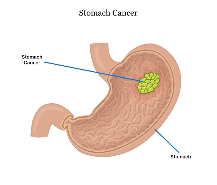 Stomach Cancer Symptoms