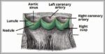 The Aortic Valve Sinuses and Coronary Arteries Diagram