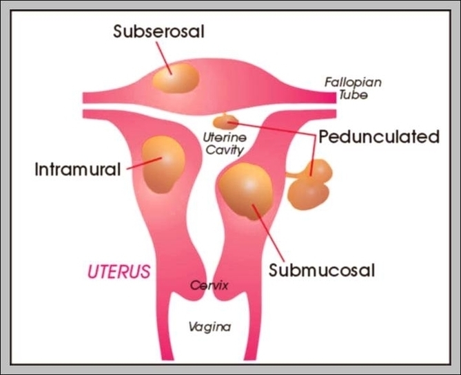 The Uterus Image