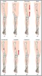 Types Of Fracture Image