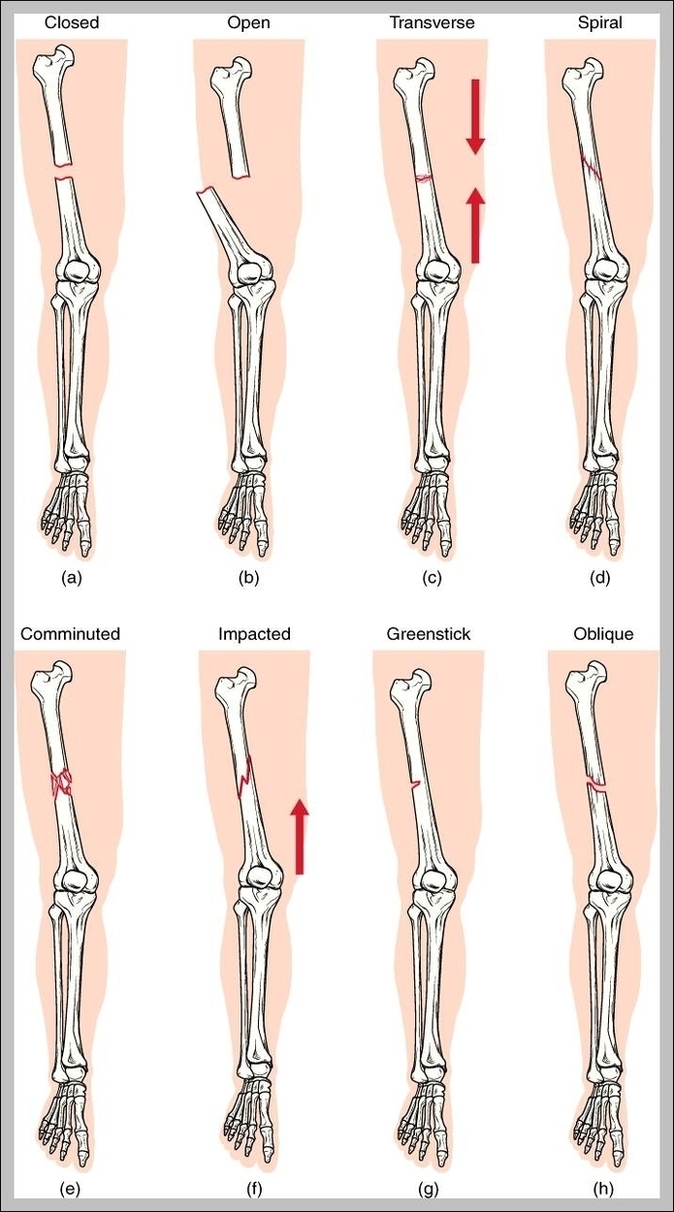 Types Of Fracture Image
