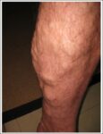 Varicose Vein