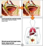 advanced prostate cancer