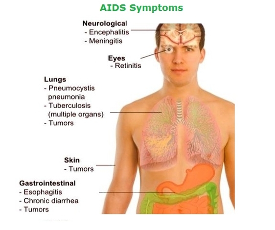 aids symptoms