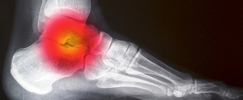 ankle pain xray