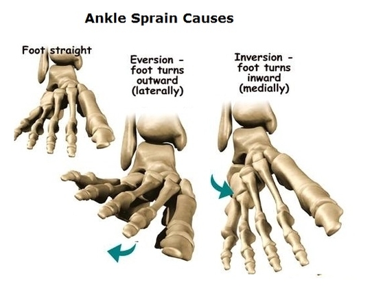 ankle sprain causes