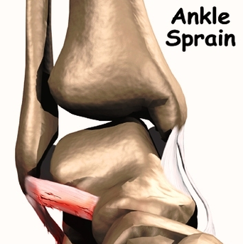 ankle sprain chart