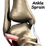 ankle sprain intro