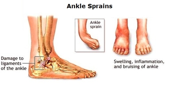 ankle sprains diagram