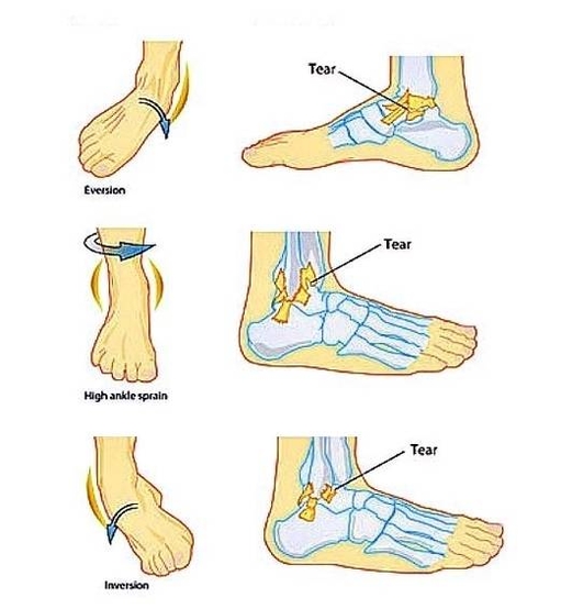 ankle sprains types