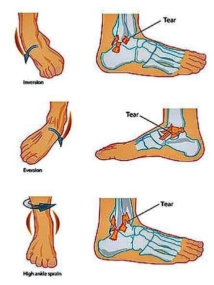 ankle sprains types1