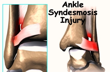 ankle syndesmosis diagram
