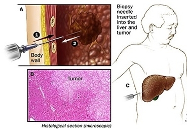 biopsy focal tumor