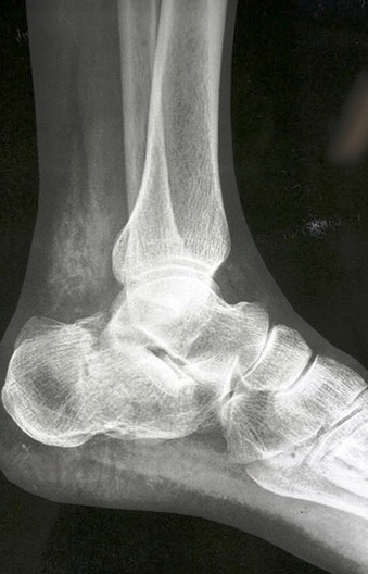 broken foot ray sized