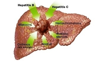 causes hepatocellular carcinoma
