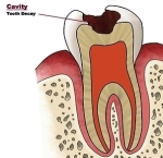 cavity tooth decay small