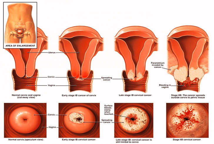 cervical cancer screening bchjzgid