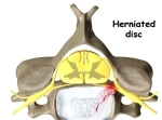 cervical discectomy rationale