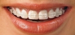 clear braces austin orthodontist