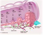 colon cancer