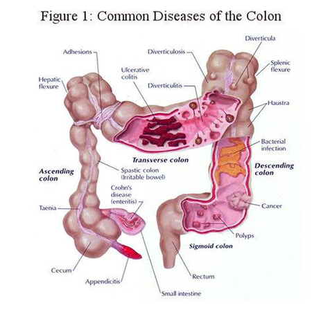 colon cancer diagram