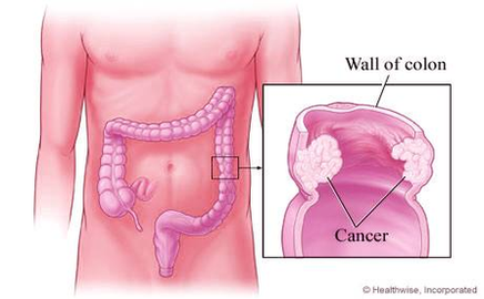 colon cancer explained