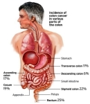 colon cancer incidence