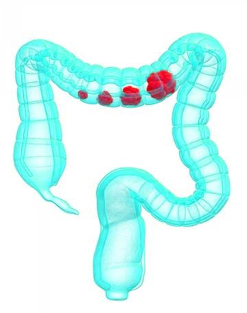 colon cancer screening image